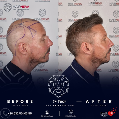 Hair Transplant before and after photo