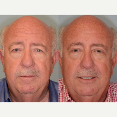 Brow Lift before and after photo