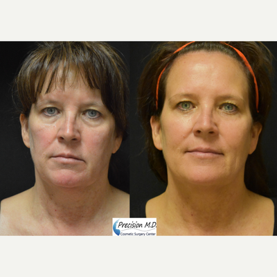 Thread Lift before and after photo