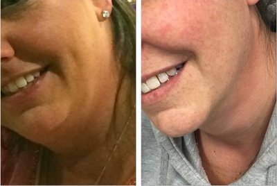 Kybella before and after photo