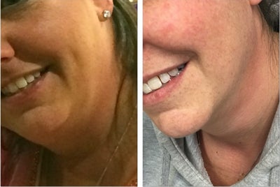 Kybella before and after photo