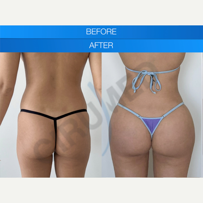 Butt Implants before and after photo