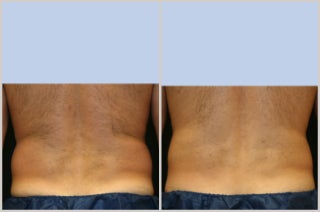 CoolSculpting before and after photo