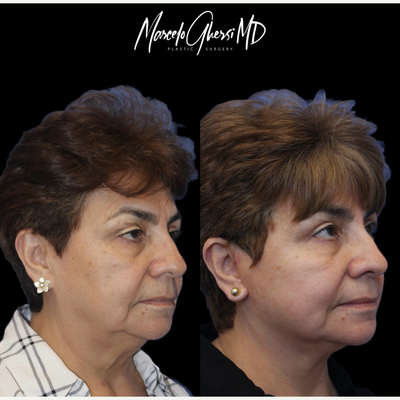 Facelift before and after photo