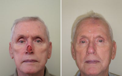 Mohs Surgery before and after photo