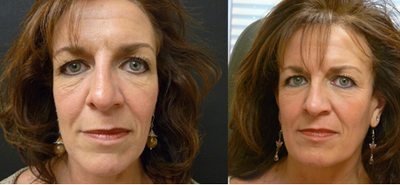 Sculptra before and after photo