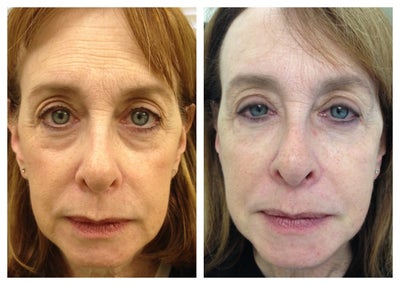Sculptra before and after photo