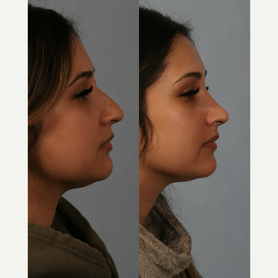 Rhinoplasty before and after photo