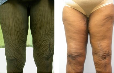 Thigh Lift before and after photo