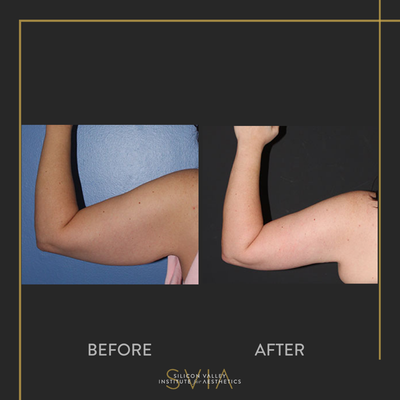 Arm Lift before and after photo
