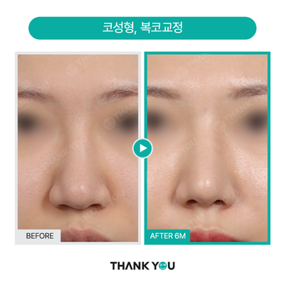 Asian Rhinoplasty before and after photo