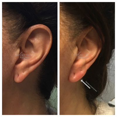 Juvederm before and after photo