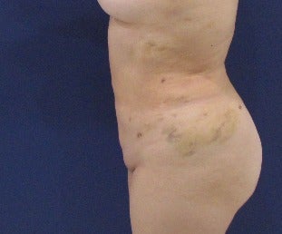 https://fi.realself.com/full/d/6/4/Liposuction-after-3663957-2825190-T1477674151.144.jpg