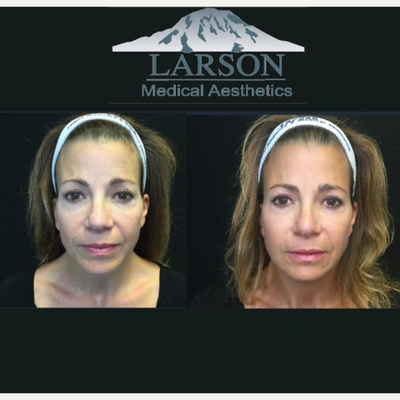 Bellafill before and after photo