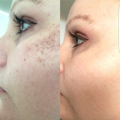 Skin Rejuvenation before and after photo