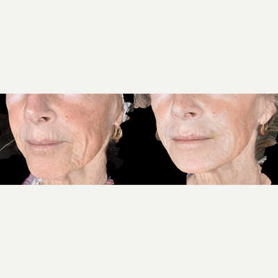 Bellafill before and after photo