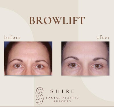 Brow Lift before and after photo