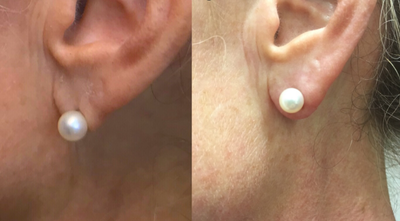 Dermal Fillers before and after photo