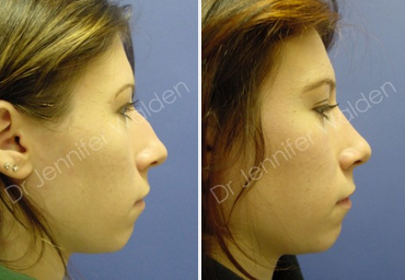 Rhinoplasty before and after photo