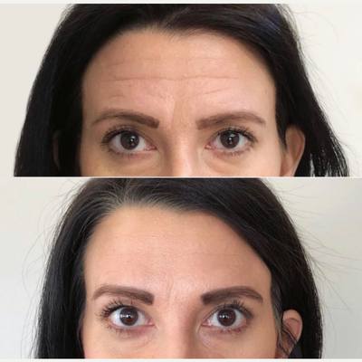 Botox before and after photo
