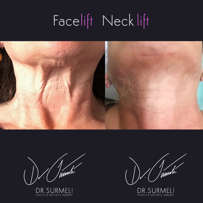 before and after image
