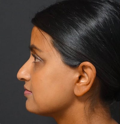 Rhinoplasty before and after photo