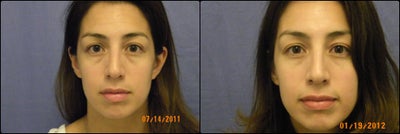 Eyelid Surgery before and after photo