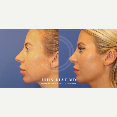 Rhinoplasty before and after photo