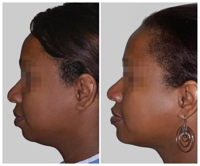 Genioplasty before and after photo