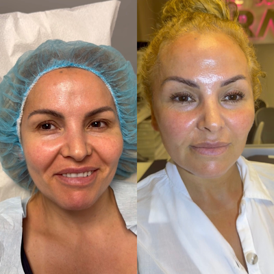 CO2 Laser before and after photo