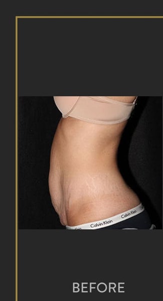 Tummy Tuck - Echelon Surgical Specialists