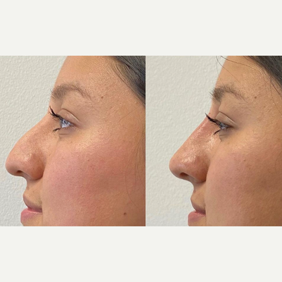 Nonsurgical Nose Job before and after photo