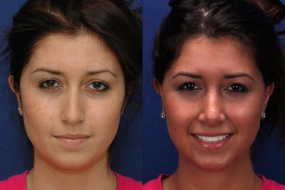 Rhinoplasty before and after photo