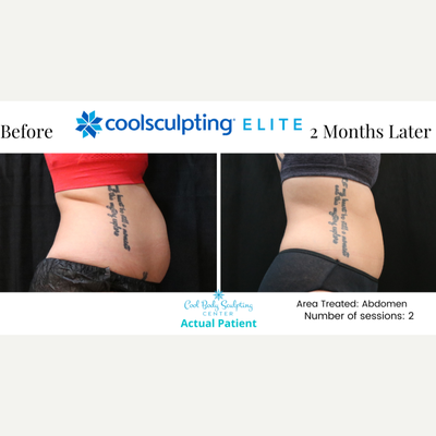 1 CoolSculpting Provider in Hampton Roads - Cool Body Sculpting Center