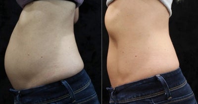 Vanquish before and after photo