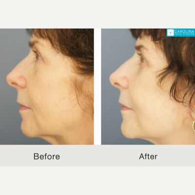 Mini Facelift before and after photo