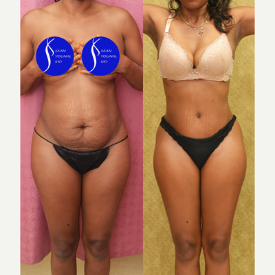 Tummy Tuck before and after photo