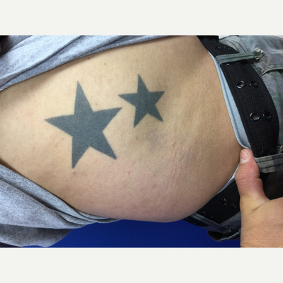 Now Offering a 20% Military Discount on Tattoo Removal! | Infinite Allure