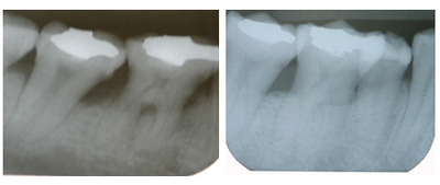 Tooth Repair before and after photo