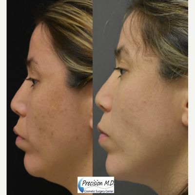 PicoWay before and after photo