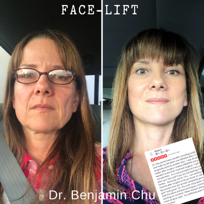 Facelift before and after photo