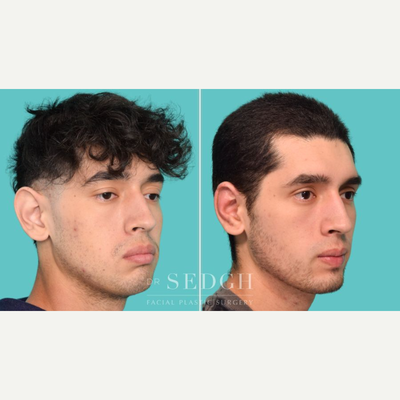 Ear Surgery before and after photo