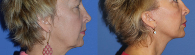 Lip Fillers before and after photo