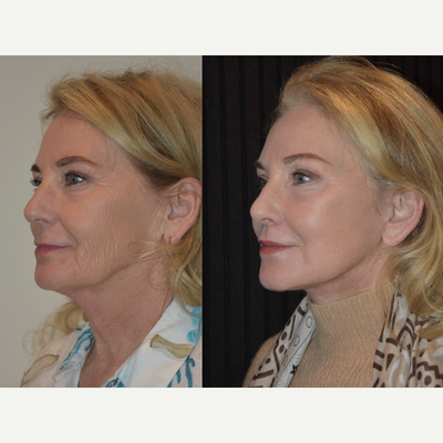 Lip Lift before and after photo