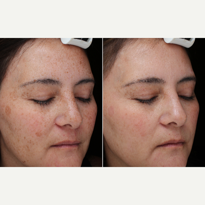 PicoSure before and after photo