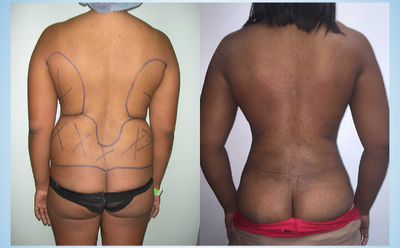 Liposuction before and after photo