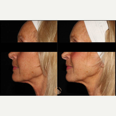 Restylane before and after photo