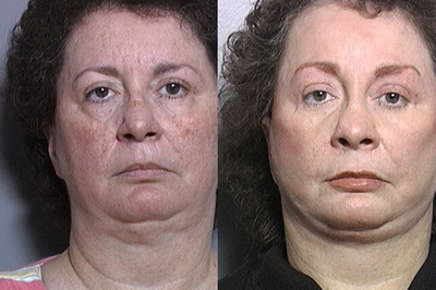 CO2 Laser before and after photo
