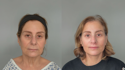 Facelift before and after photo
