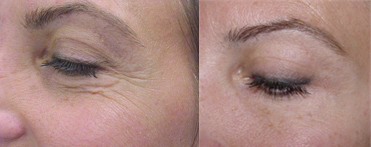 Botox before and after photo